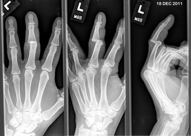 X-ray of dislocated fingers