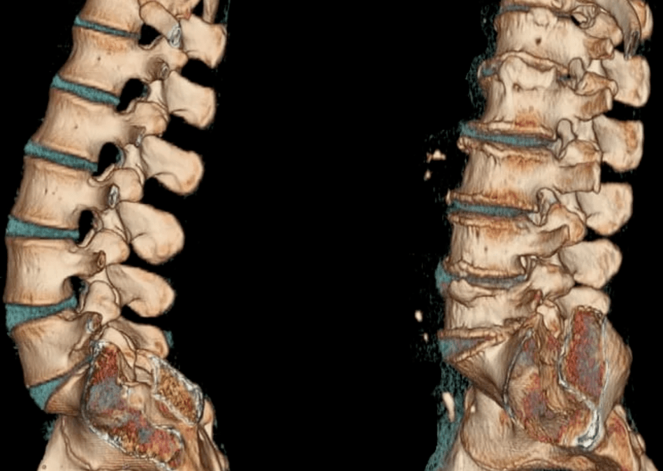 osteochondrosis