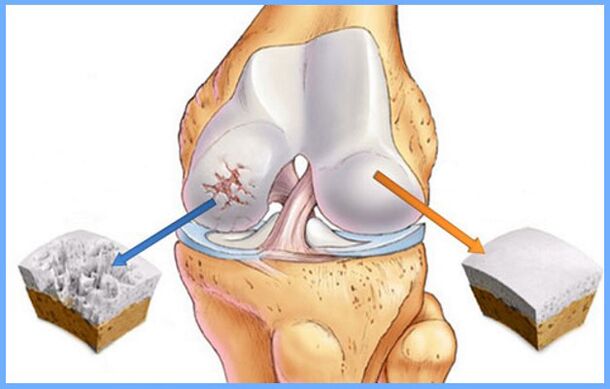 Normal and osteoarthritic knee joint