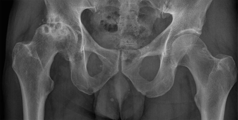 Deforming osteoarthritis of the hip joint on x-ray