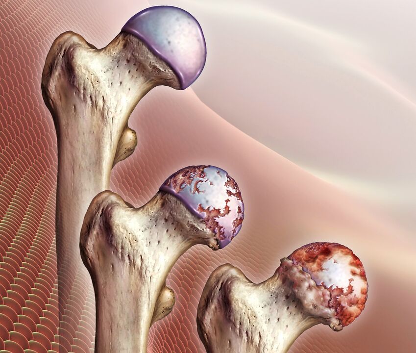 The development of osteoarthritis of the hip joint