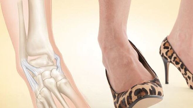 wearing shoes with heels as a cause of osteoarthritis of the ankle