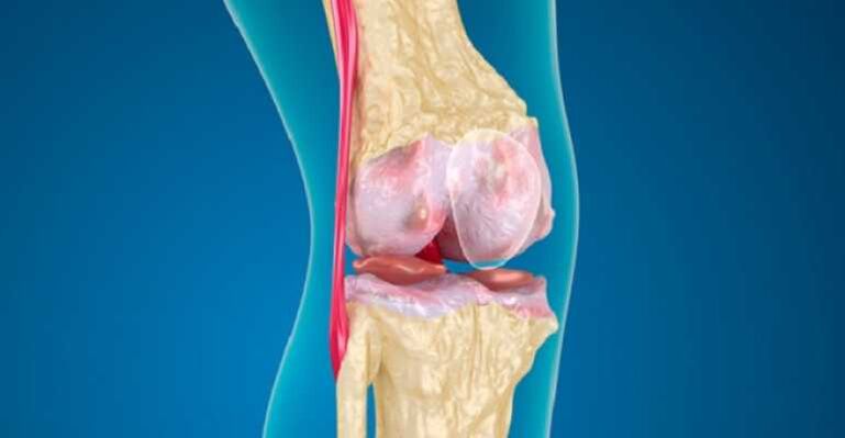 Arthrosis of knee joint disease, which causes the destruction of the cartilage in the joints