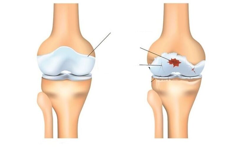 Healthy and patient with arthrosis joints